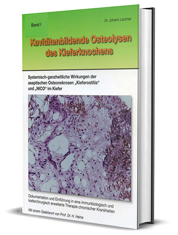 Volume I (german) „Cavity forming osteolyses of the jawbone“ Dr. Dr. (PhD-UCN) Johann Lechner